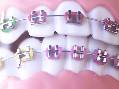 Traditional Metal Braces