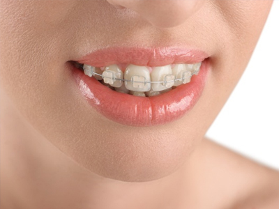 Ceramic Braces